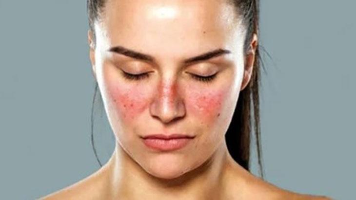 Yüzünüzdeki lekeler lupus belirtisi olabilir! Pek çok organı tetikliyor